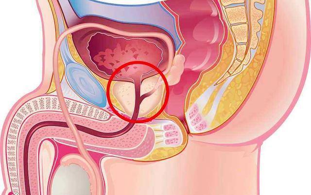 前列腺炎最新疗法，探索奇妙之旅的启程点