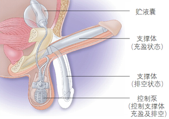 最新阴茎假体植入价格详解与科普讨论