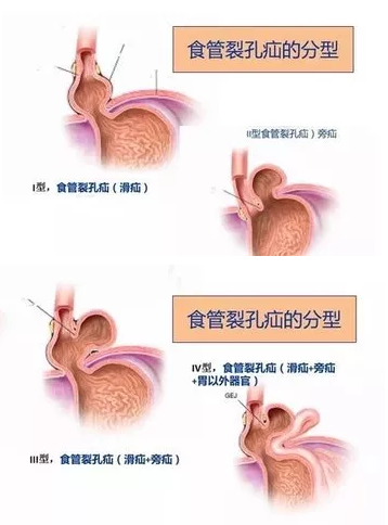 腺肌症最新治疗方法详解与论述