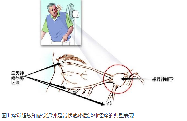 带状疱疹后遗神经痛最新治疗方法探讨