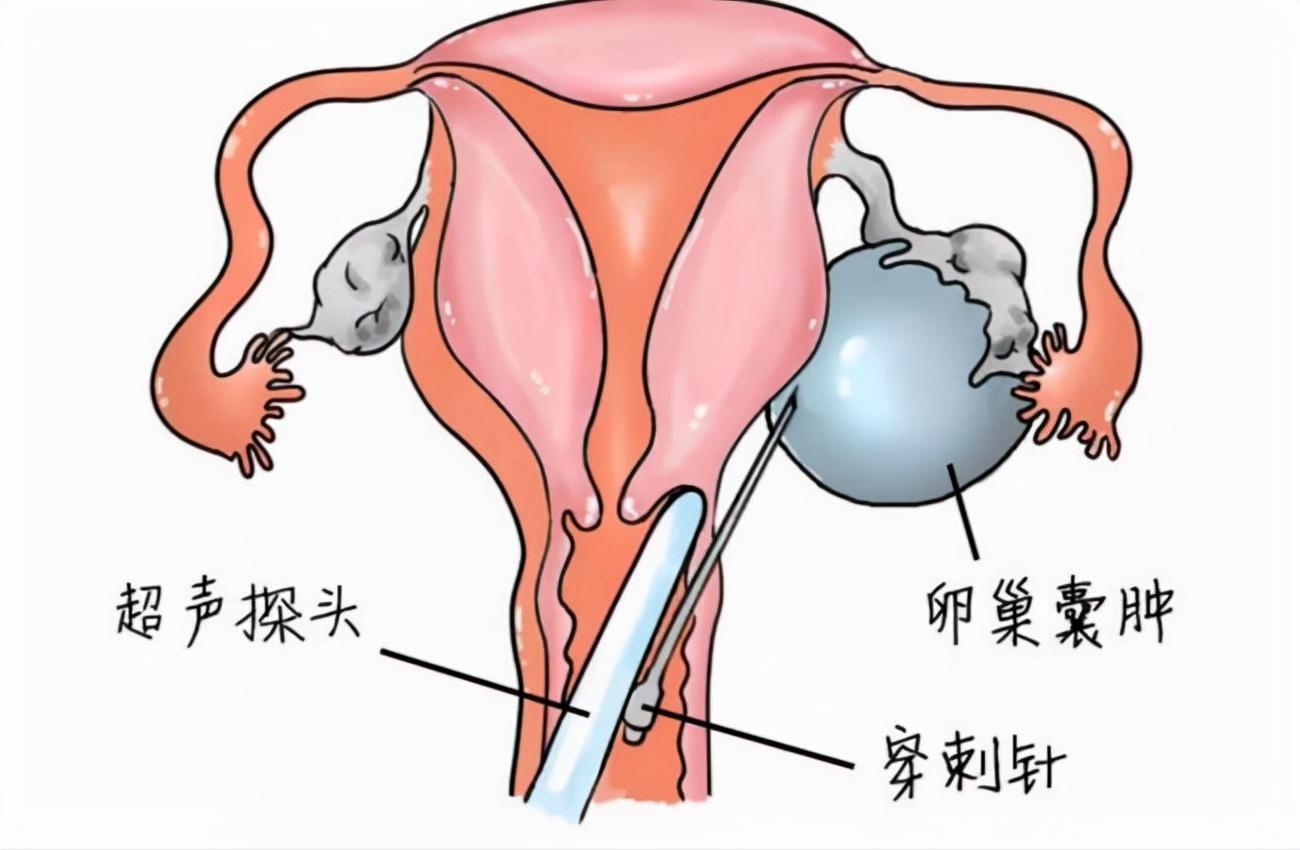 青春期宫血最新治疗方法,青春期宫血最新治疗方法，科技之光照亮健康之路