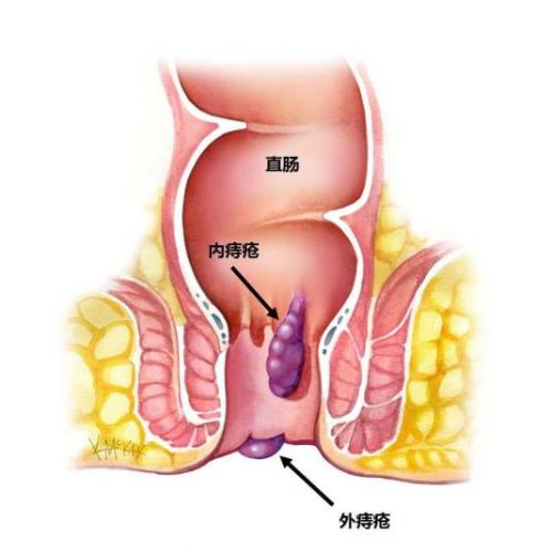 痔疮手术最新技术,痔疮手术最新技术步骤指南